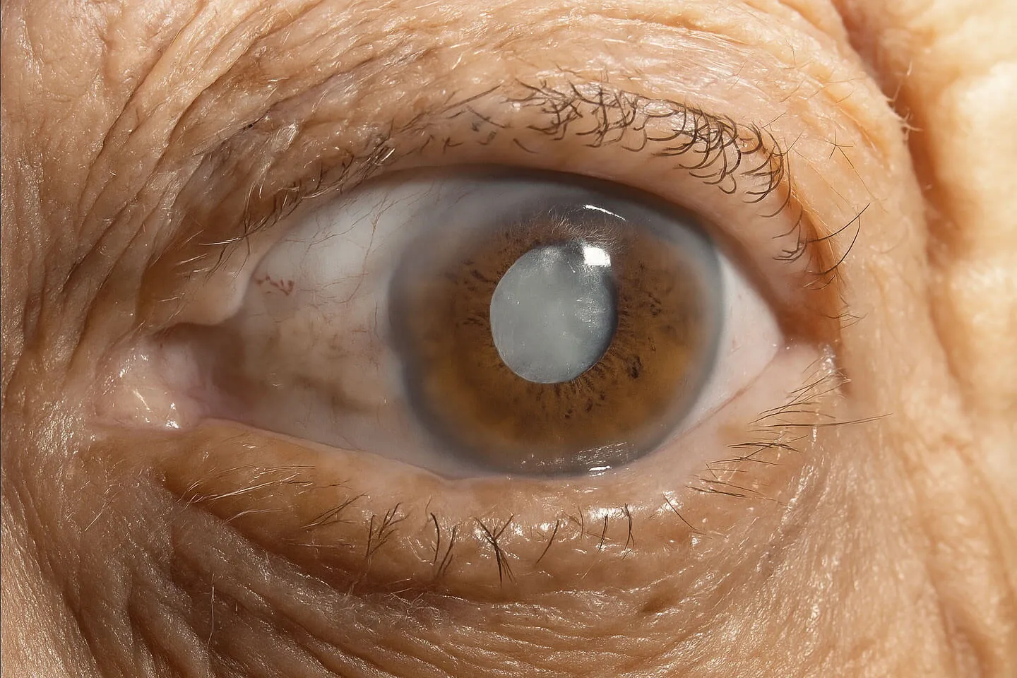 Ojo con catarata avanzada en adulto mayor. Diagnóstico común tratado por el Dr. Francisco Alain Matabuena en Querétaro y Celaya