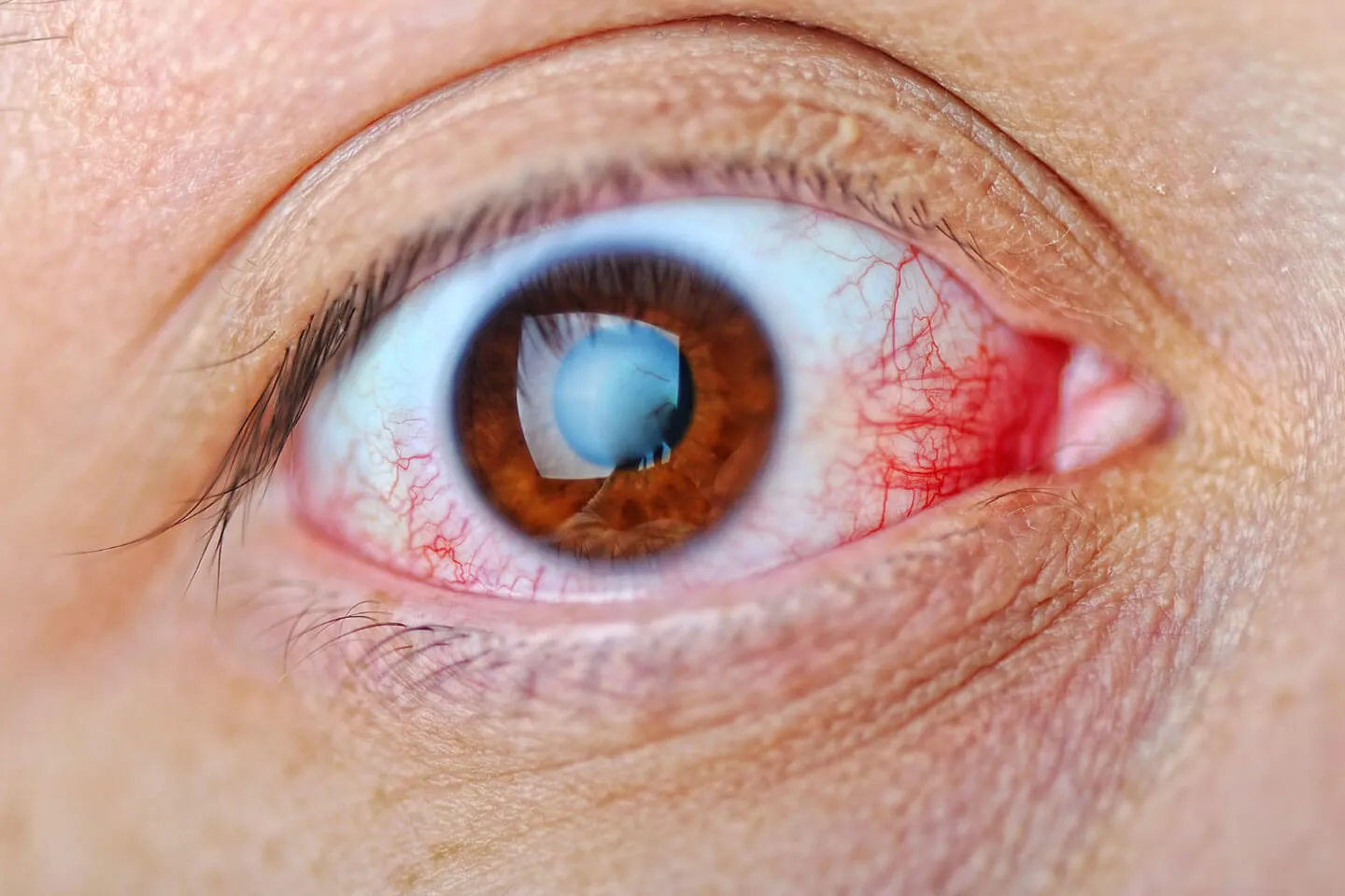 Examen ocular por sospecha de glaucoma. Diagnóstico especializado por el Dr. Francisco Alain Matabuena en Querétaro y Celaya